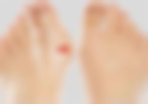 五、去掉点痣留下的凸起疤痕的注意事项