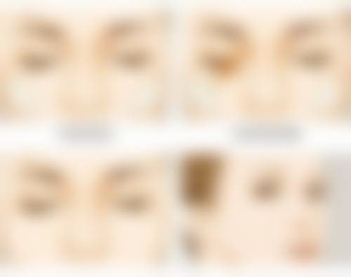 {双眼皮眼角多久拆线最好？术后5 - 7天是关键，愈合情况等因素需考量！ 