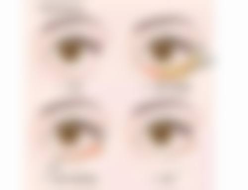 三、双眼皮眼角拆线的至佳时间及原因