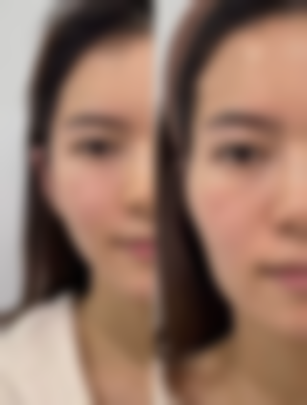 三、怎么样去除疤痕疙瘩之手术联合放疗