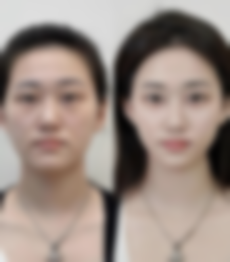 二、怎么样去除疤痕疙瘩之光电治疗