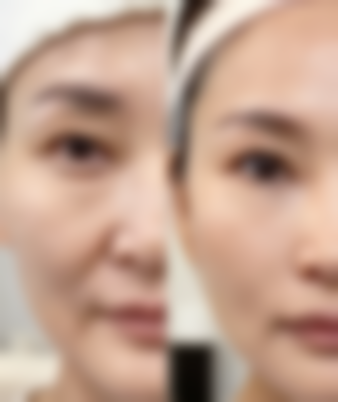 双眼皮眼角多久拆线更好？关键还是得看情况！