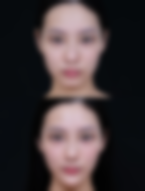 五、抽脂以后塑身衣要穿多久：修复期间的其他注意事项