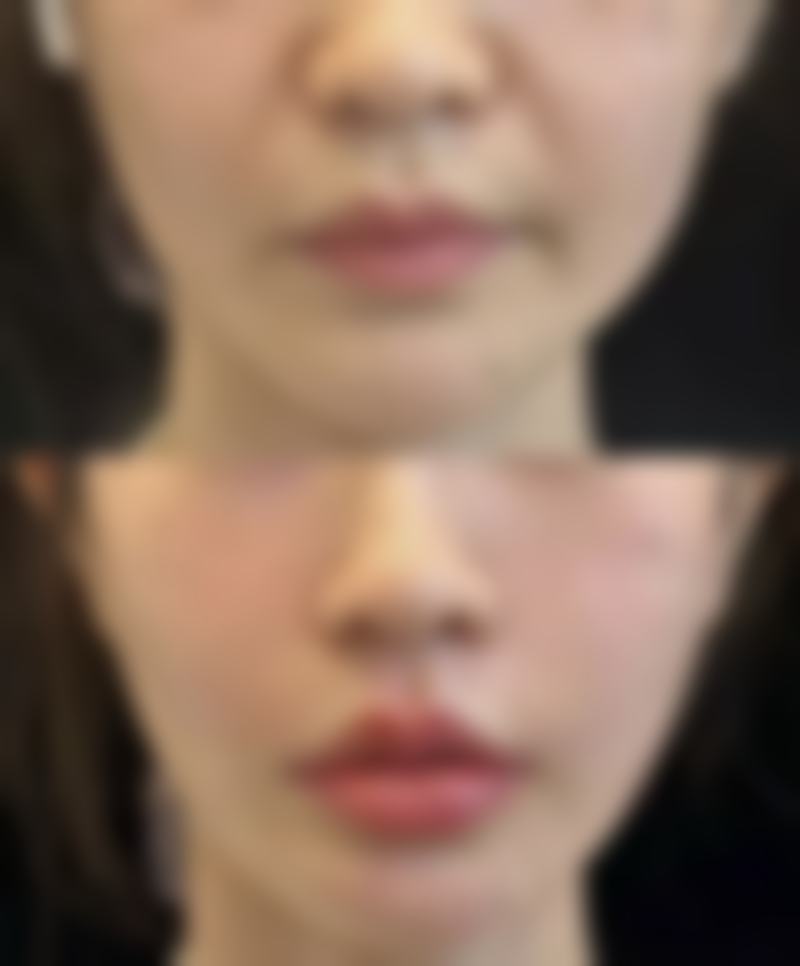 一、阴道紧缩手术多久能同房：术后修复时间的影响因素