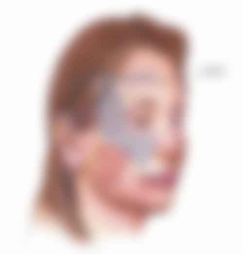 三、痘痘留下的疤痕治疗注意事项