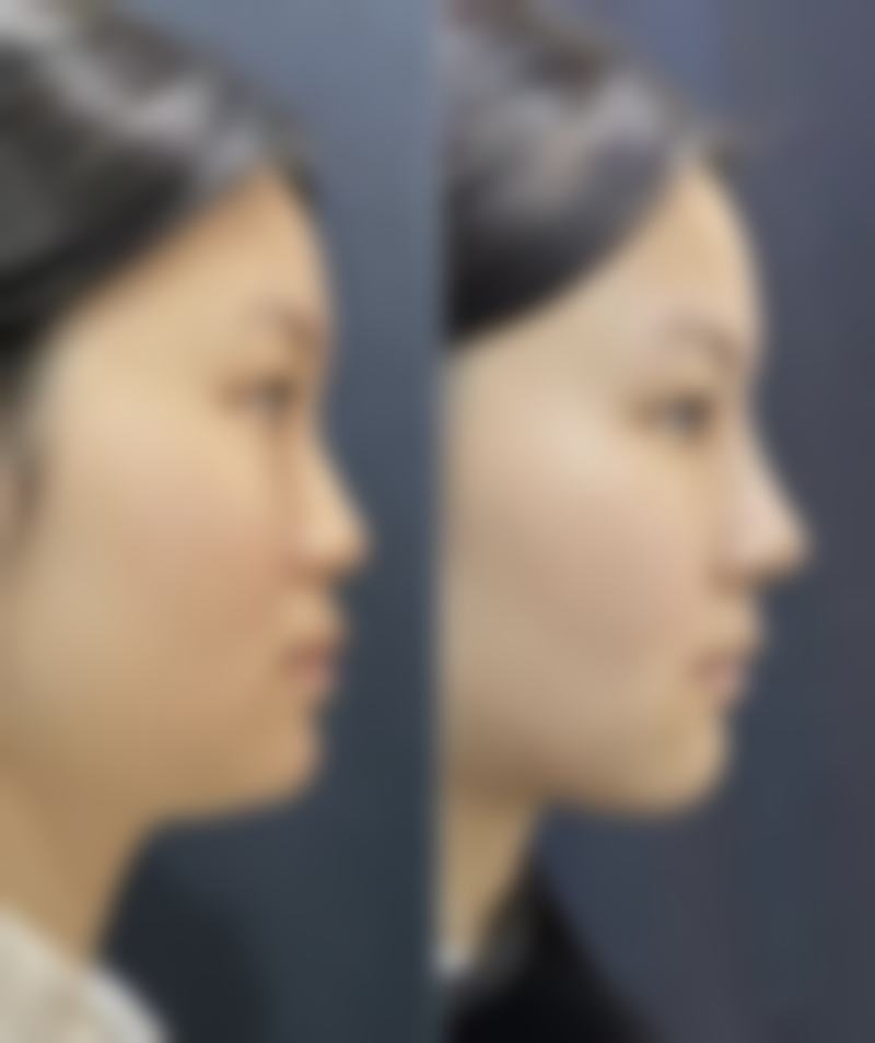 一、做完双眼皮多久可以用祛疤产品