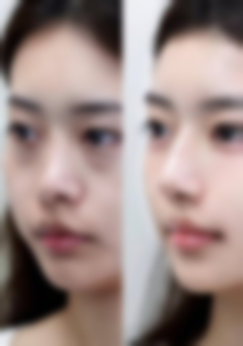 {一只眼睛三眼皮一只眼睛双眼皮怎么办？多原因分析及改善方案来帮你！ 