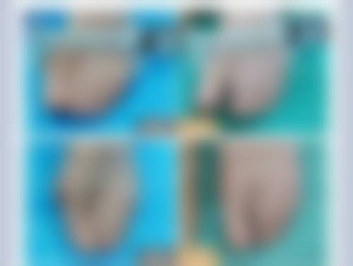 {为什么双眼皮大眼睛容易有黑眼圈和眼袋？解析成因与有效改善方法 