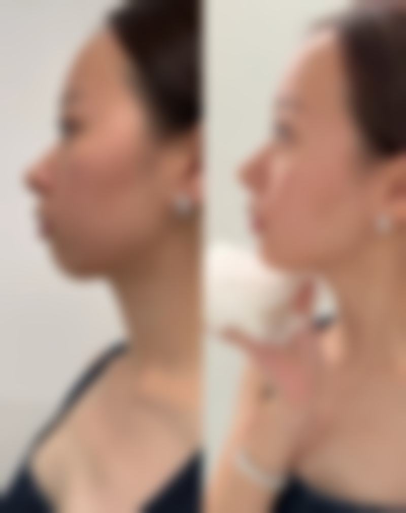 三、术后哺乳需注意的问题