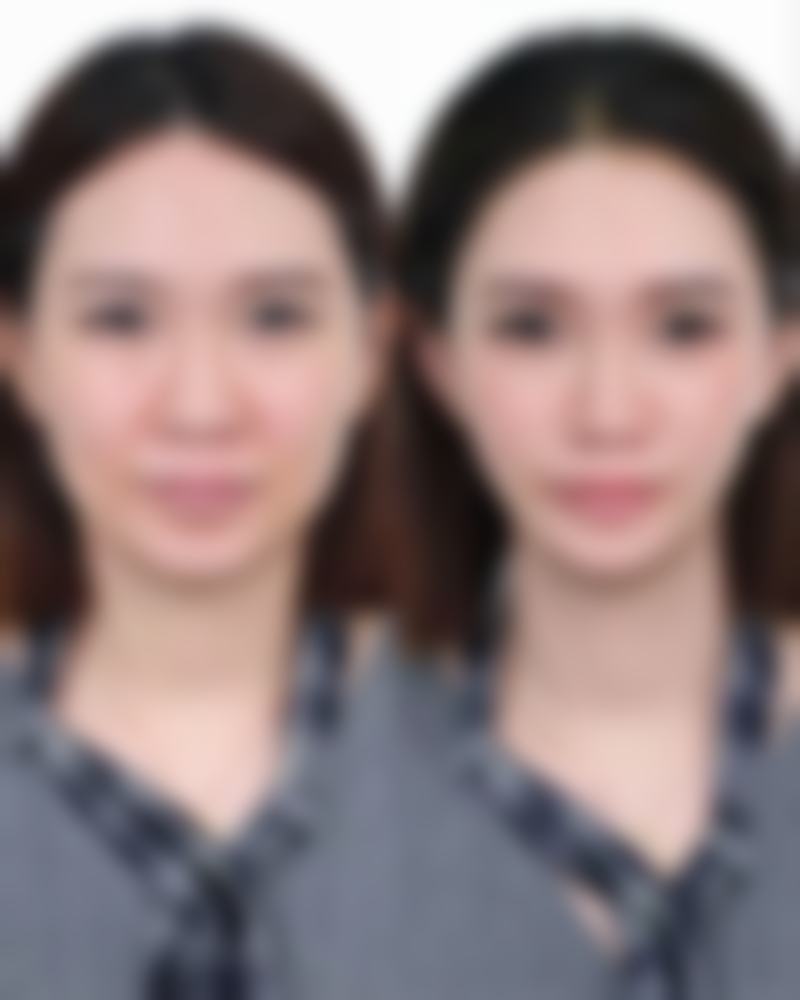 一、隆胸后能否喂奶的决定因素