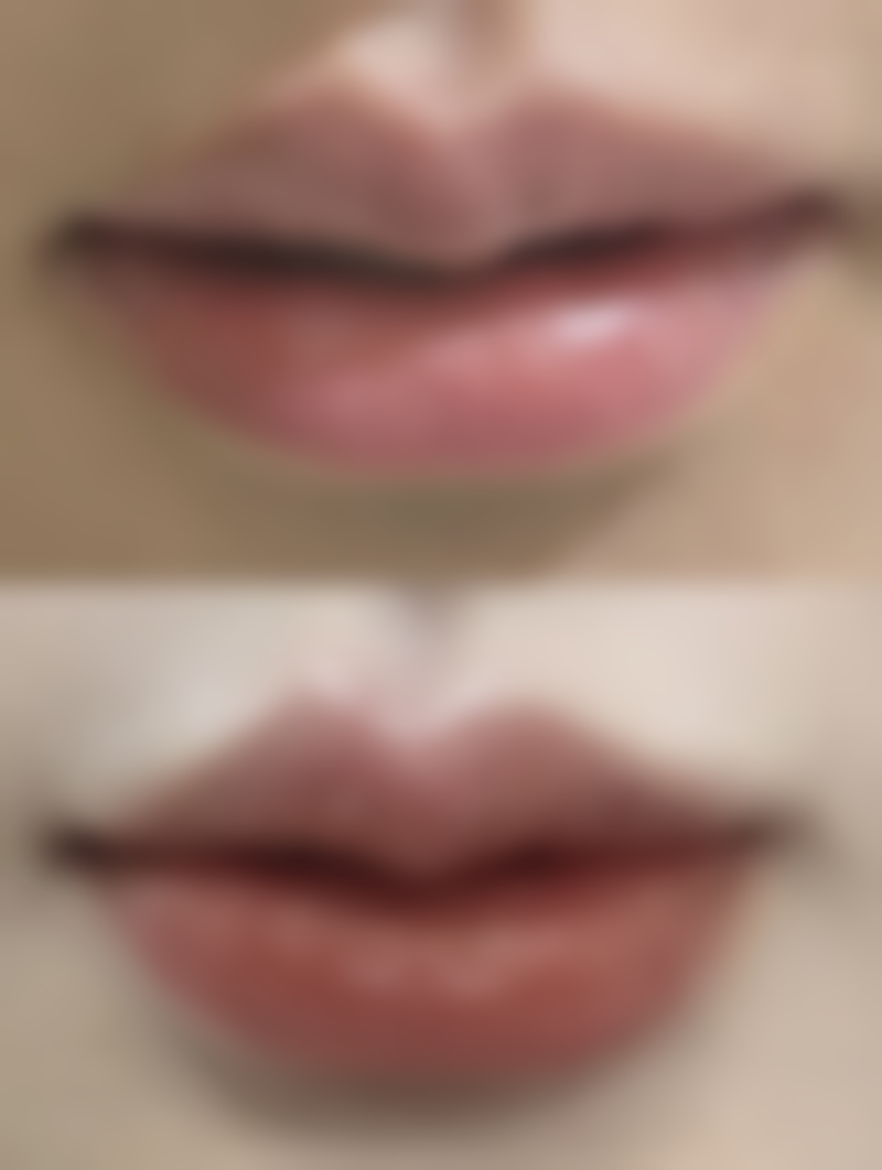 一、隆鼻后早期为何不建议侧睡