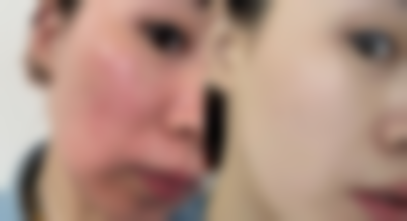 三、头发种植术后的特殊情况