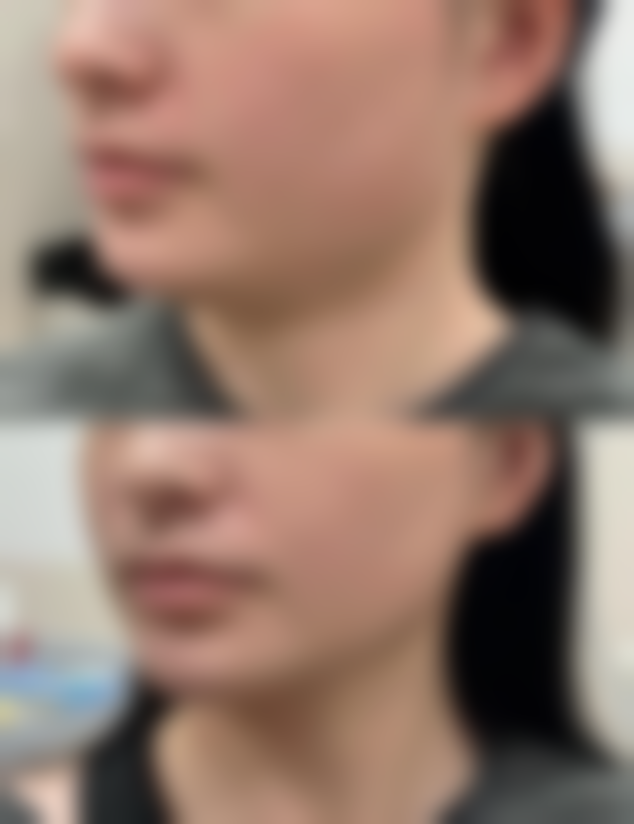 {隆鼻后可以侧睡吗？不同阶段侧睡影响不一，这些注意事项助你恢复理想鼻型 