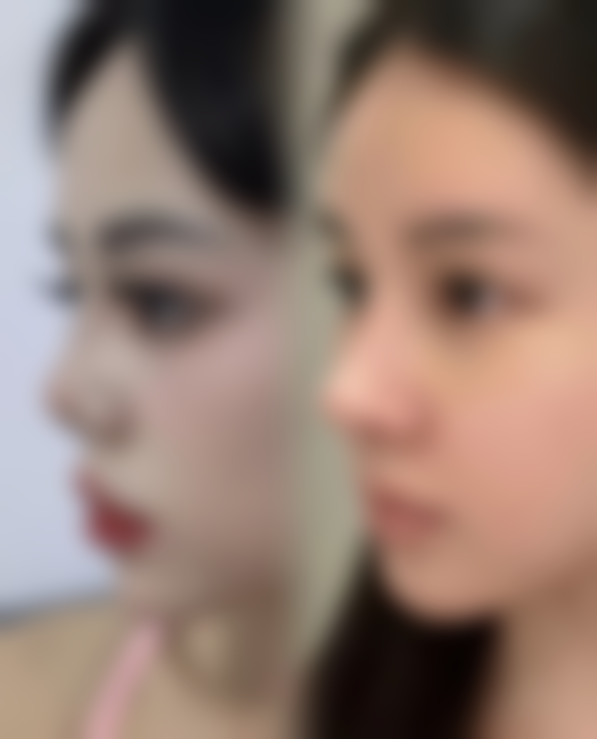 二、做眼袋内切跟外切在成效上的区别