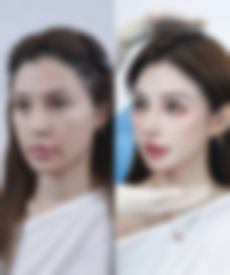 六、理性对待全切双眼皮手术