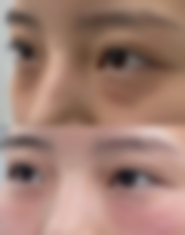 二、影响头发种植成活的因素