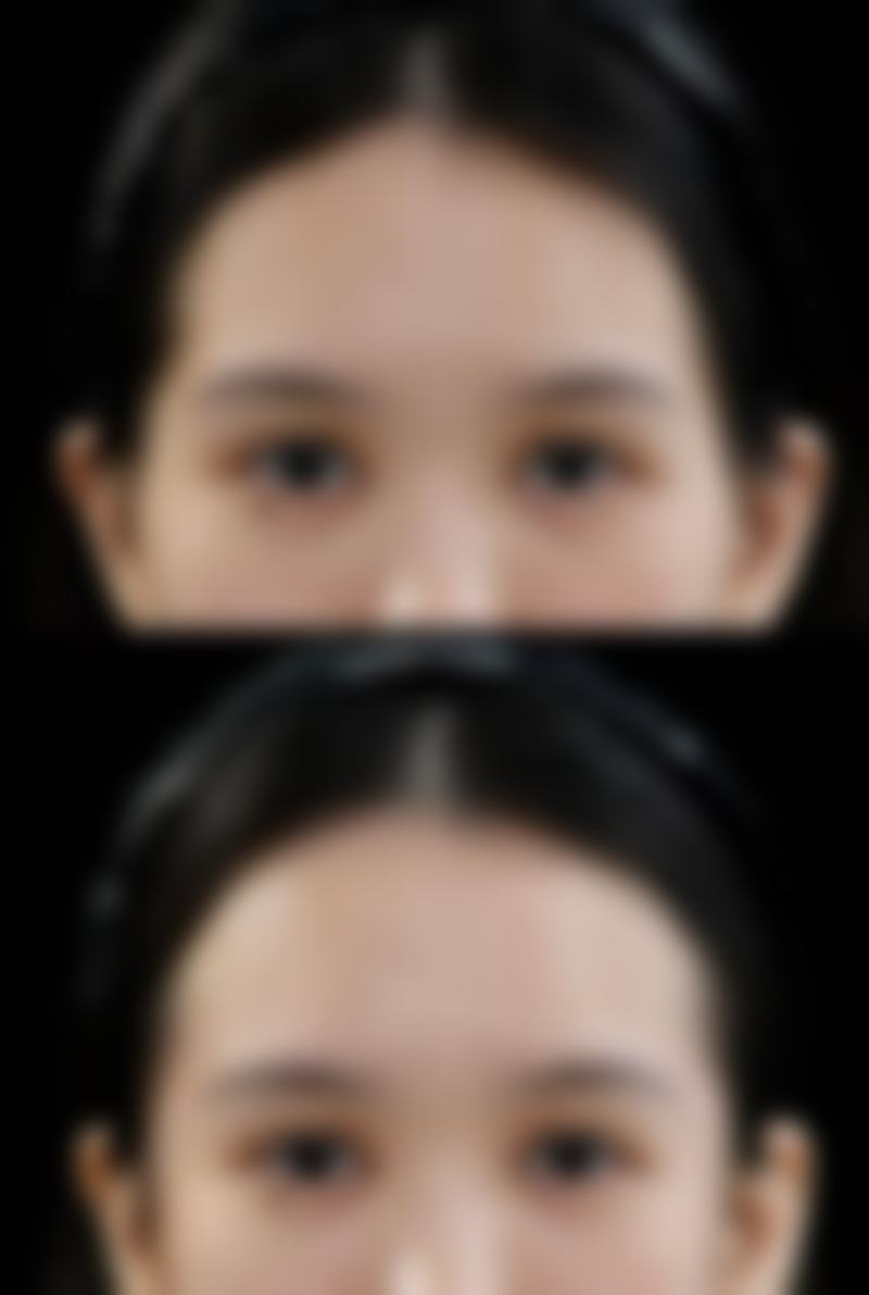 {埋线多久可以做全切双眼皮手术？3 - 6 个月是关键期，恢复情况决定时机 