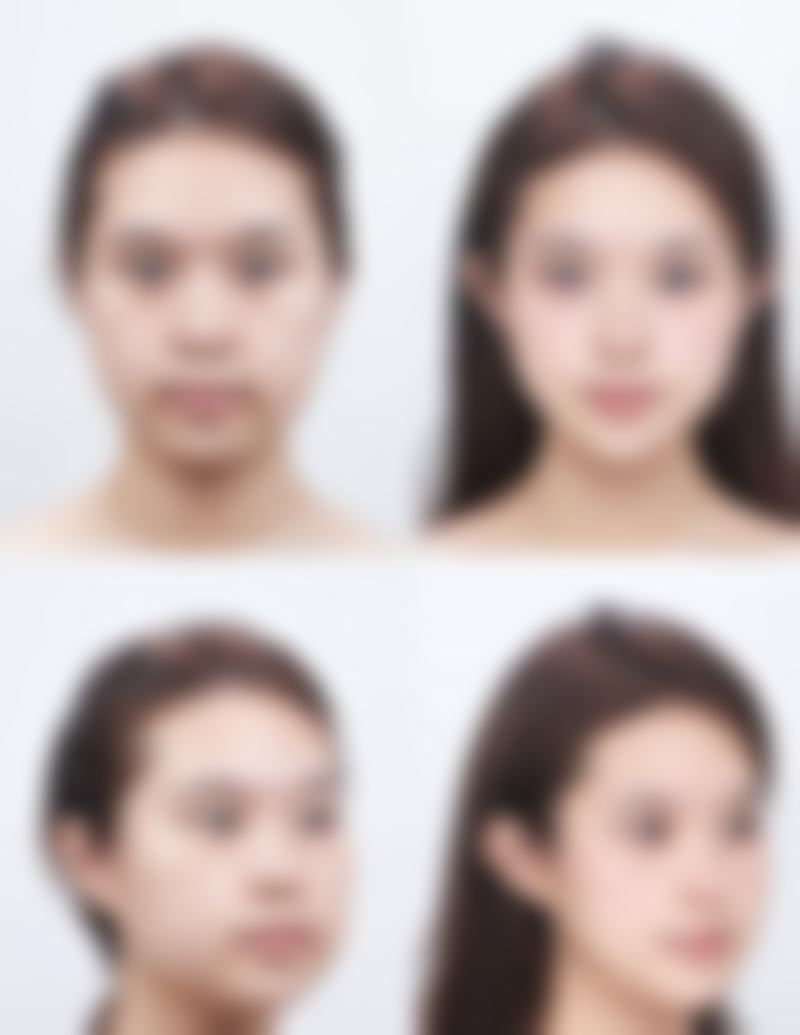 四、取出隆胸假体的并发症预防