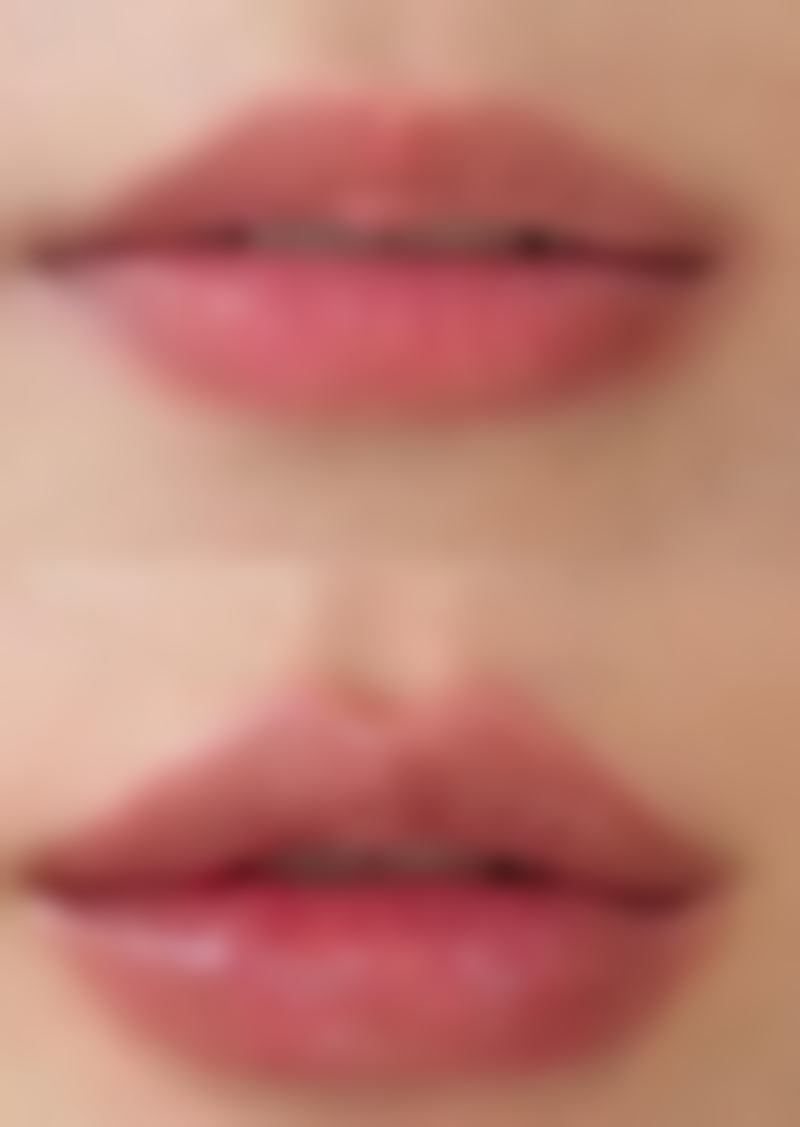 六、做疤痕激光手术以二氧化碳激光为例的术后护理