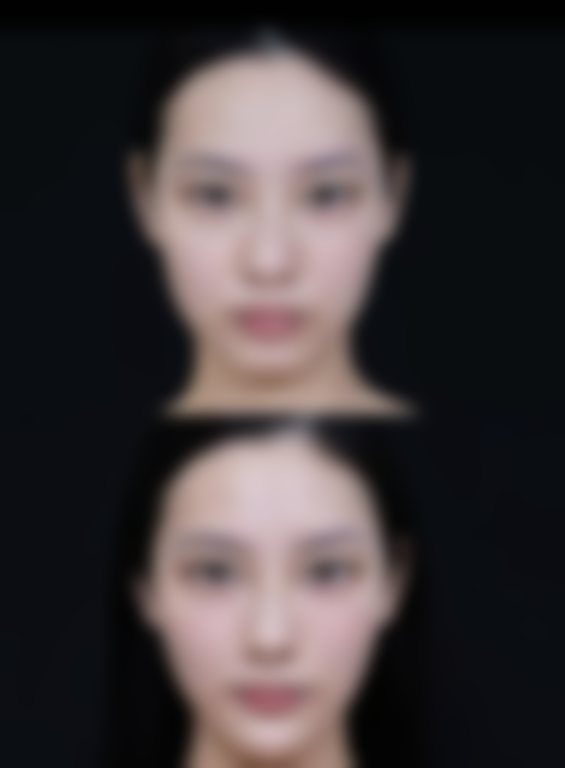 二、不同类型眼袋的治疗方案