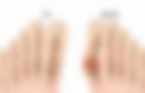 四、双眼皮与眼袋术后消肿攻略