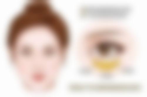 三、双眼皮分阶段修复表现与护理建议