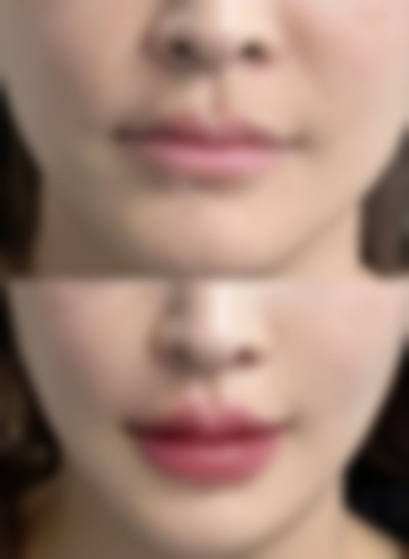 {怎么样缓解眼袋黑眼圈最有效？日常护理与医美手段结合助你焕亮眼周肌肤