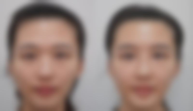 {怎么去掉很重的眼袋？这些小妙招及专业方案助你轻松告别“熊猫眼”