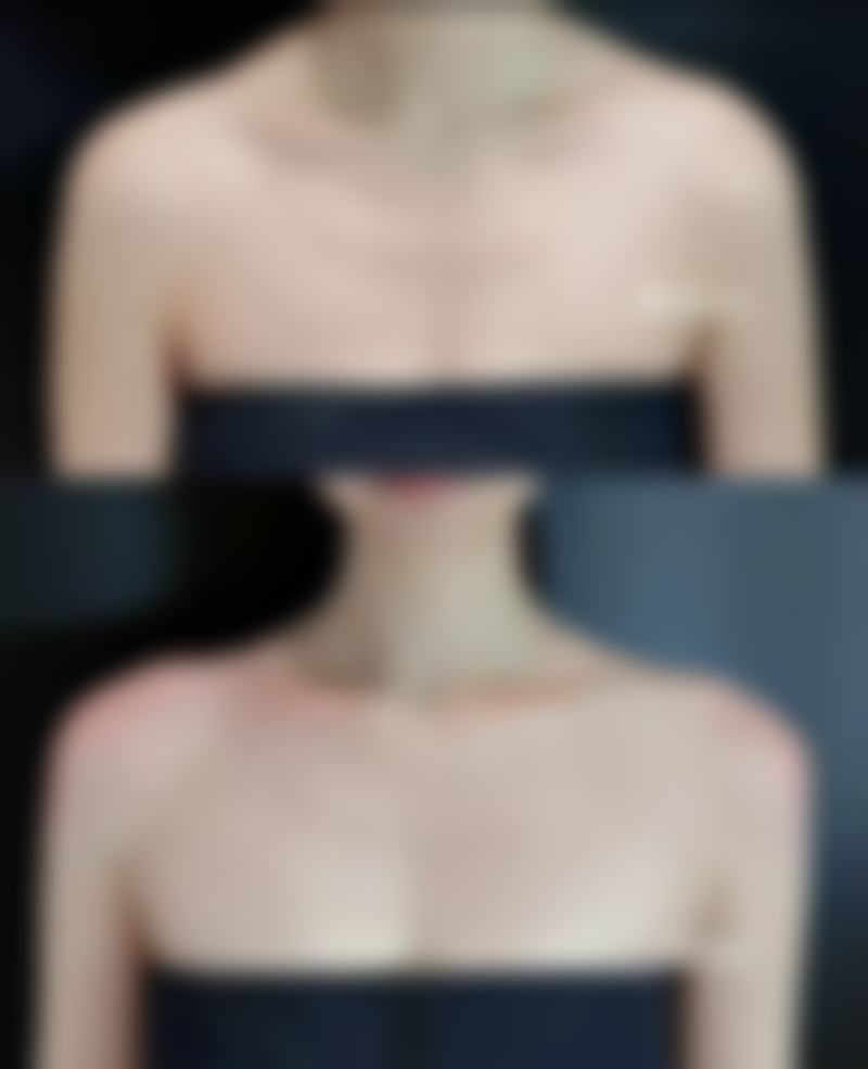 五、双眼皮多久完全消肿？特殊情况处理