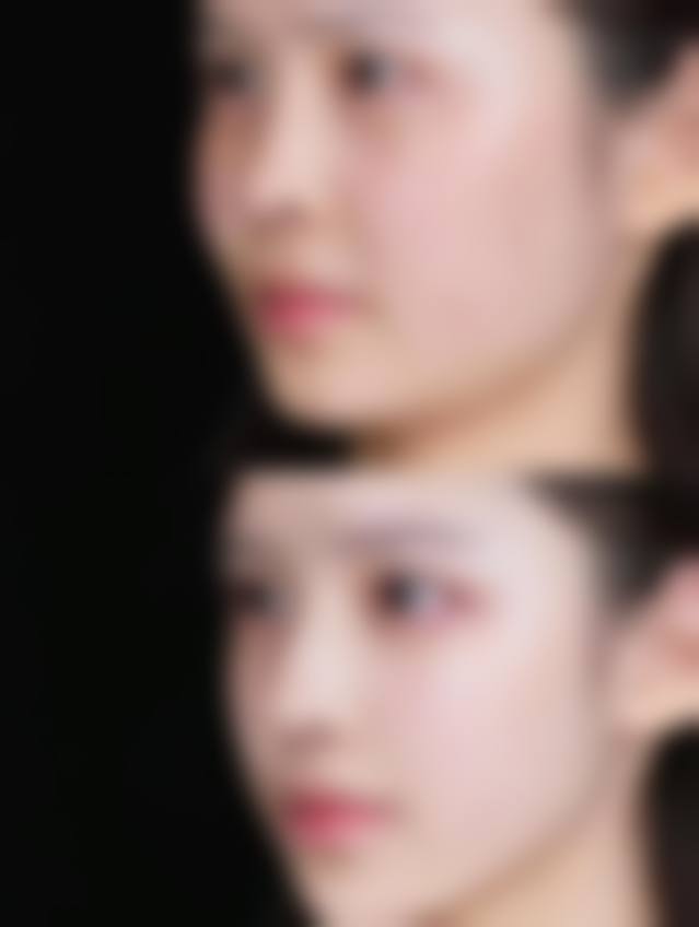 五、瘦脸针保持多长时间：日常辅助维持方法