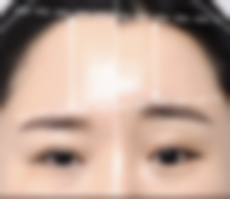 六、瘦脸针保持多长时间：理性对待医疗美容