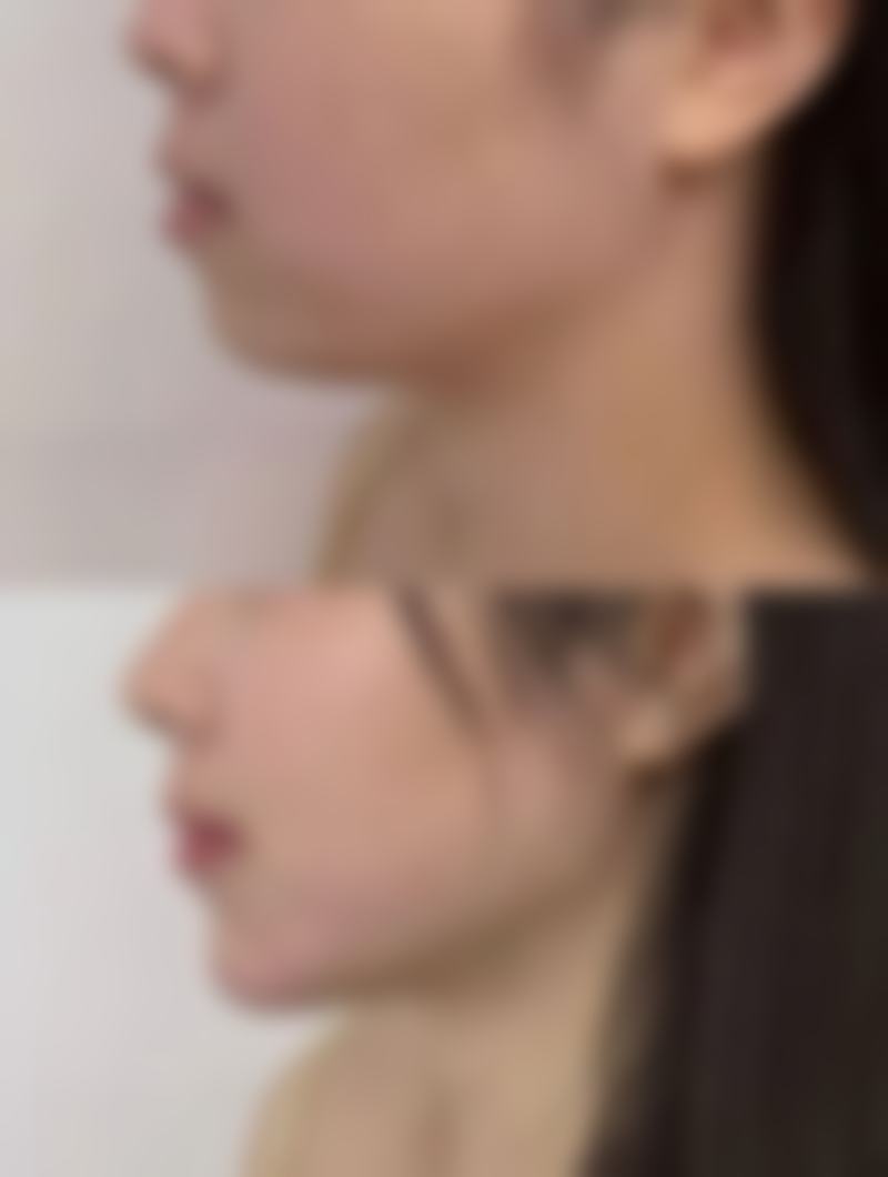 二、割双眼皮手术不同阶段的修复时间及表现