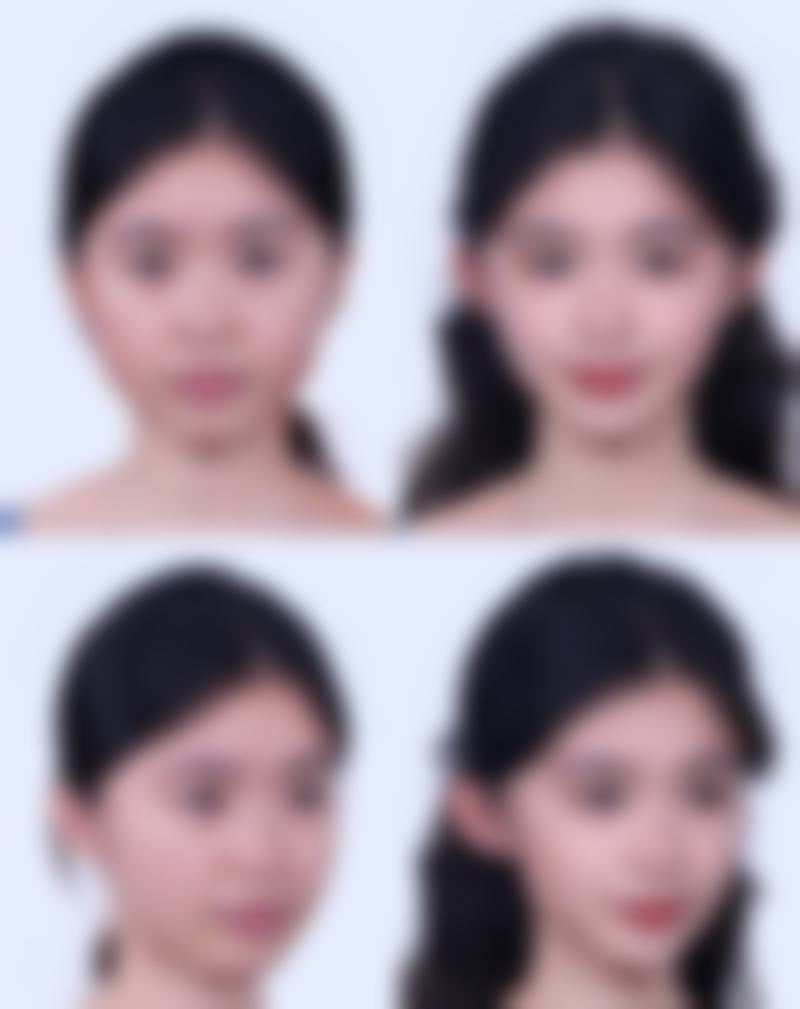 四、手术疤痕能去当兵吗之去除方法