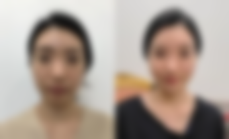 五、手术疤痕能去当兵吗之例外情况