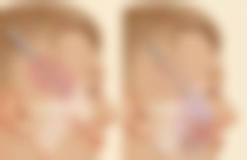 {水光除皱对身体有害吗？正规操作风险可控，了解这些让你安心变美！ 