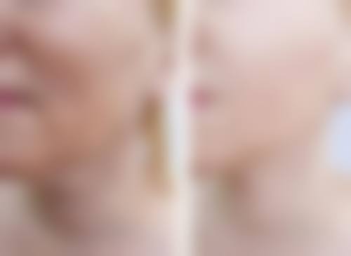 一、了解疤痕情况