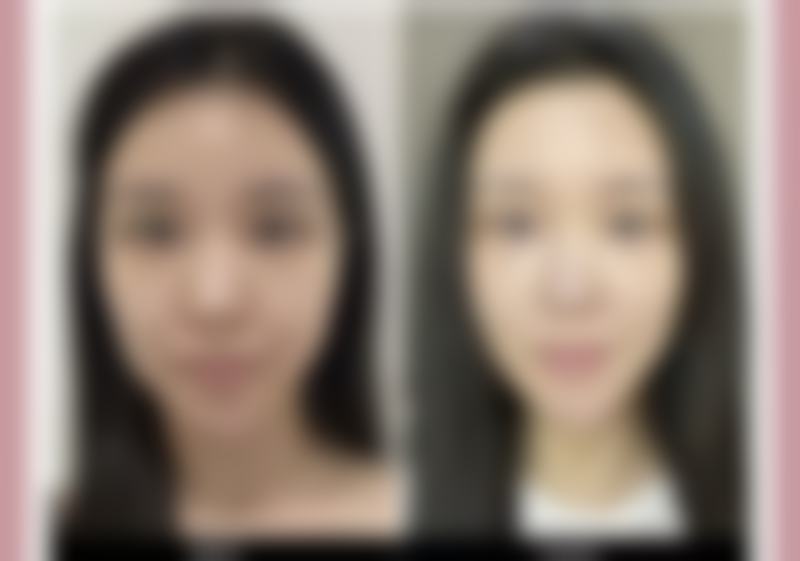 {先天性眼袋怎么去除最有效？轻医美与手术方案全解析，助你告别眼袋烦恼