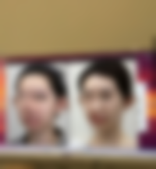 二、评估眼袋重度程度