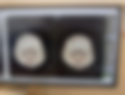 三、手术去除先天性眼袋方案