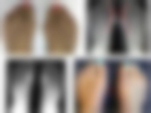 五、假体隆胸的日常维护