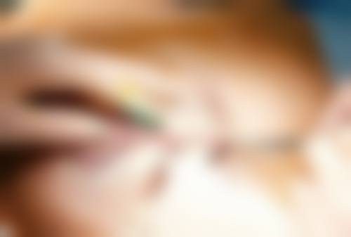 {哪种去眼袋比较好？手术、激光、射频等方法全解析，助你选对方案 