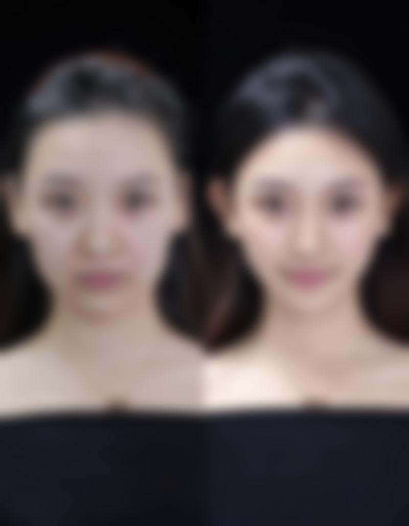 {假体隆胸多久可以把假体取出来？时间受材质、状况等因素影响，看完便知！ 