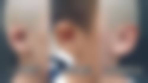 一、种植头发手术时长