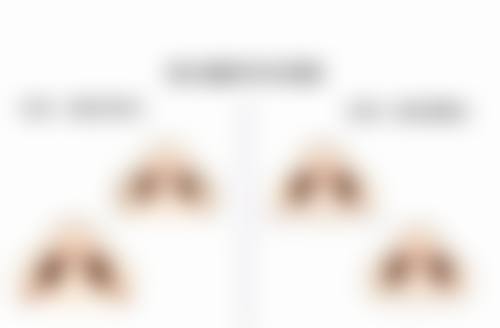 四、吸脂手术有成效吗——危害和后遗症需警惕