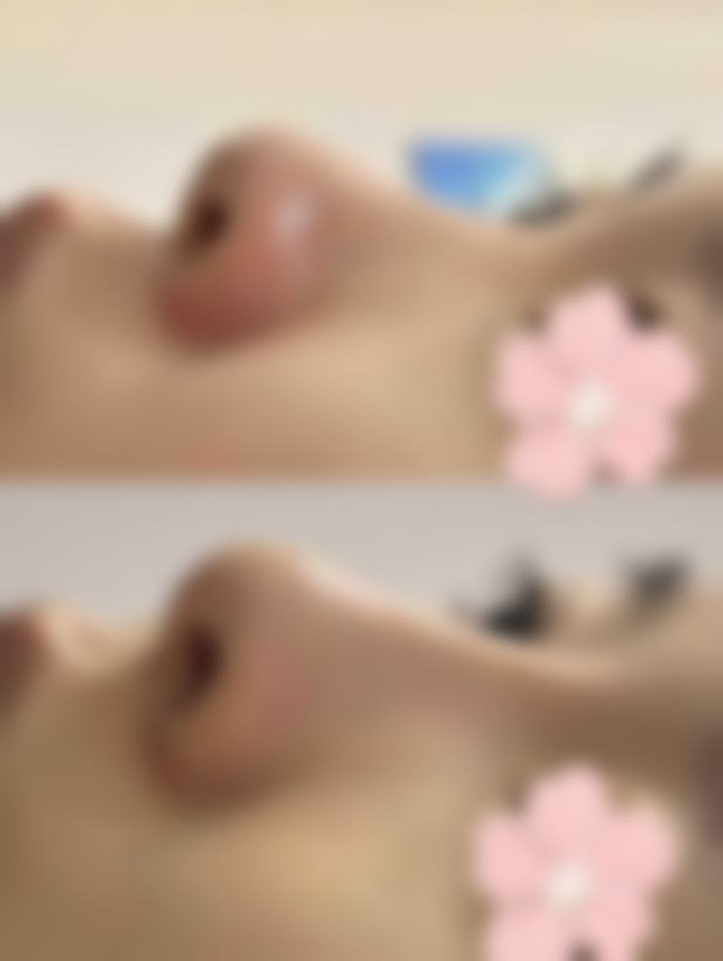 六、做双眼皮去美容院可以吗？失败后的补救措施