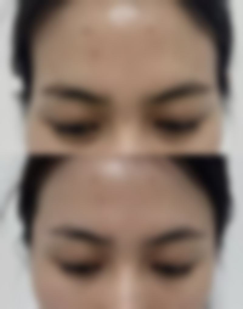 一、不同年龄段割双眼皮的考量