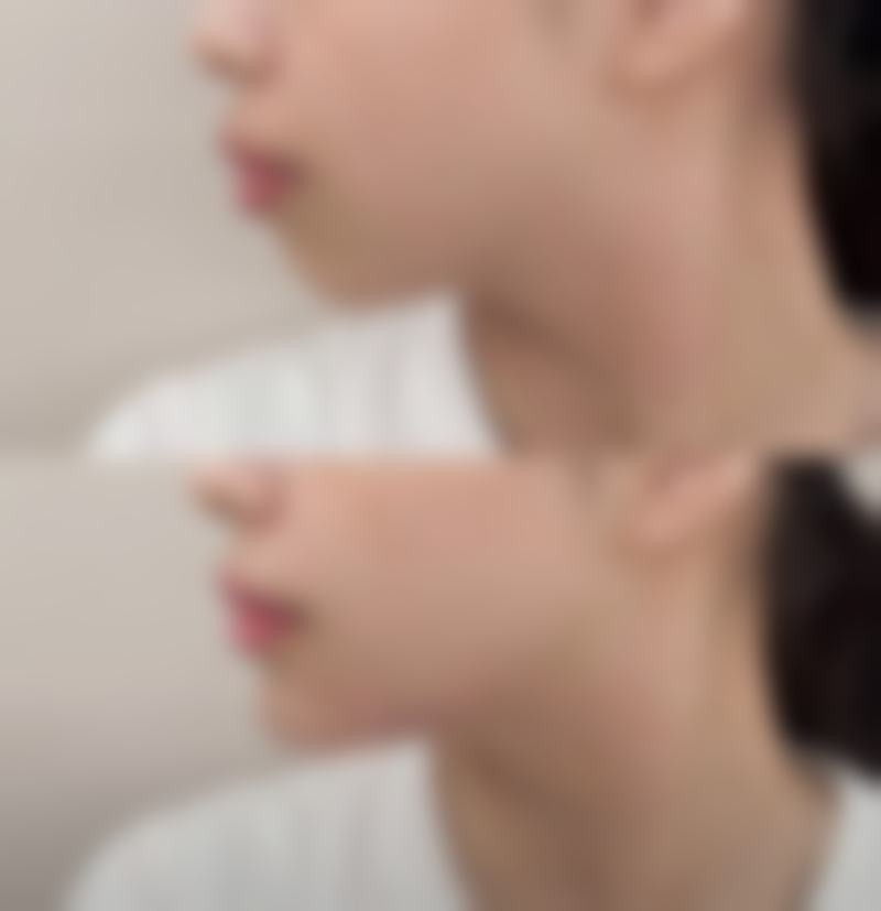 一、做双眼皮去美容院可以吗？了解双眼皮手术的本质