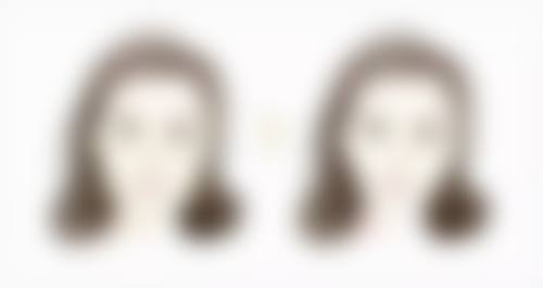 三、切眼袋疤痕增生的处理方案