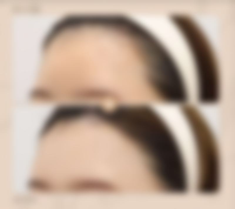 六、眼皮松弛其他处理方式简介