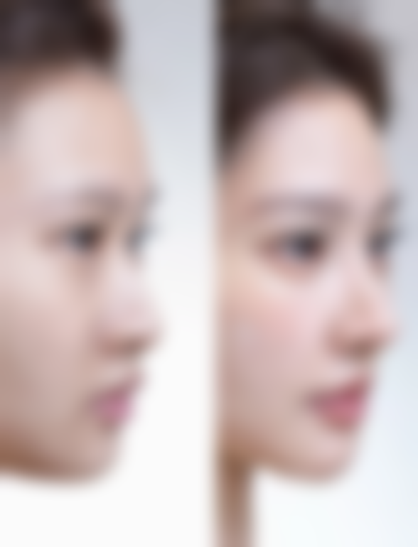 一、眼皮松弛做双眼皮能改善的原理